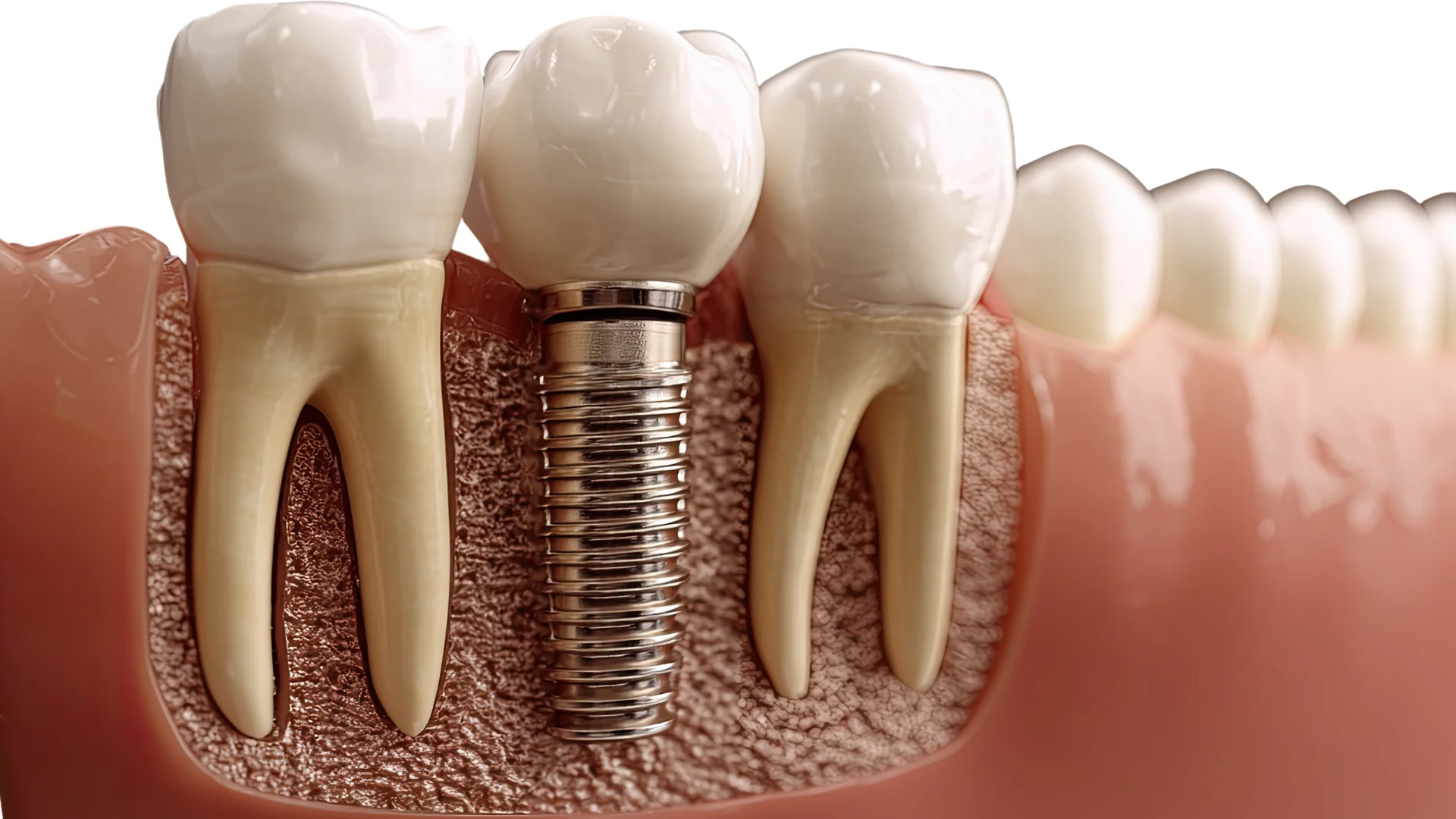 dental implant