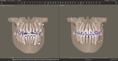 dijital-ortodonti-3