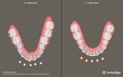 dijital-ortodonti-4