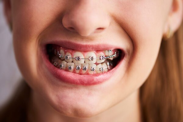 Diş Teli İçin Antalyada Hangi Doktorlar Var?