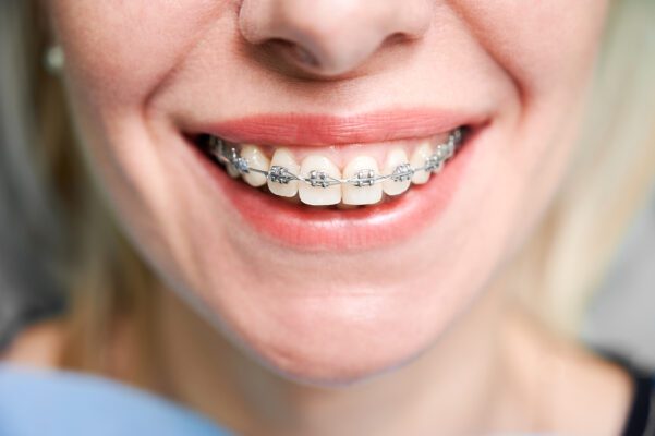 Merve Aycan ile Antalyada Diş Teli Tedavisi ve Önemi